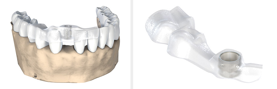 Die exakte Übertragung der Implantatplanung während des chirurgischen Eingriffs unterstützt die sichere und präzise Implantatinsertion.